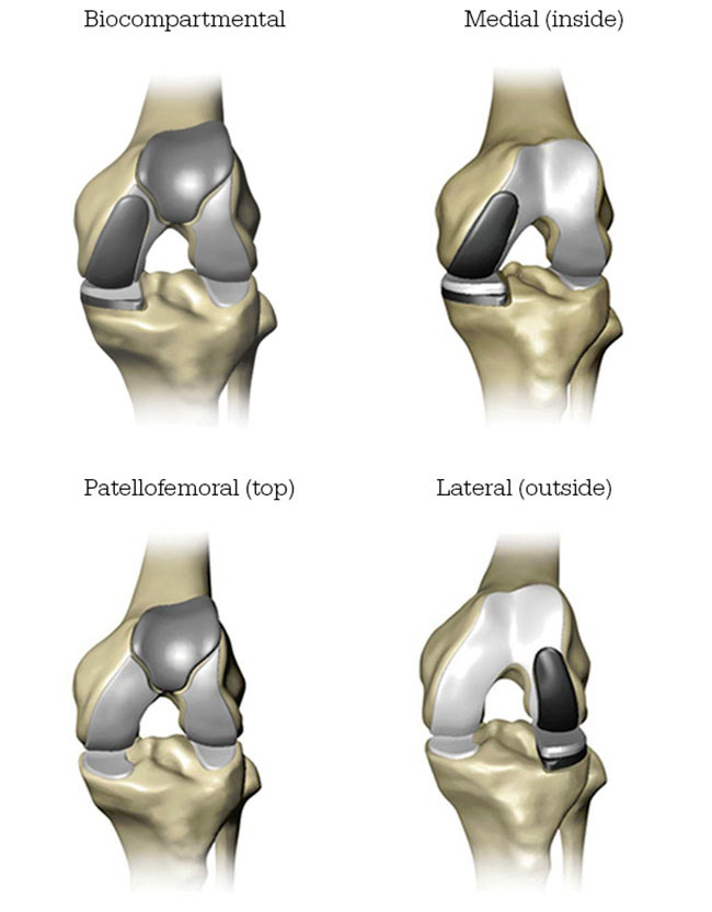 Mako Robotic-Arm Assisted Technology for Total Hip Replacement