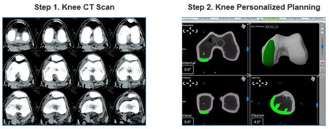 Mako Robotic-Arm Assisted Technology for Total Hip Replacement