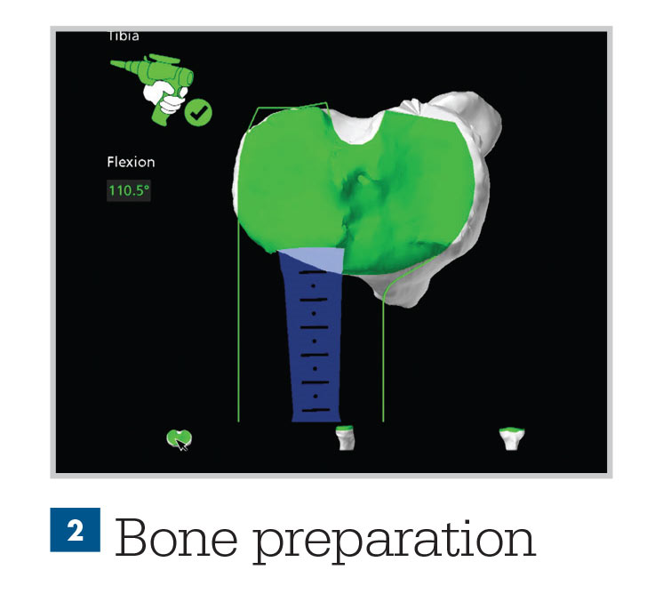 Mako Robotic-Arm Assisted Technology for Total Knee Replacement